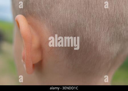 Gros plan détaillé d'une tique parasite dangereuse sur la peau de la tête d'un enfant sous les cheveux courts. Concept médical parfait pour la sensibilisation à la maladie de Lyme Banque D'Images