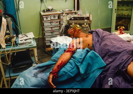 Hôpital du CICR, Kaboul (Afghanistan), août 1992 ; des chirurgiens opèrent sur une nouvelle victime de mines terrestres. Après 14 ans de guerre, le comté est un champ de mines, avec plus de 56 000 amputés. Banque D'Images