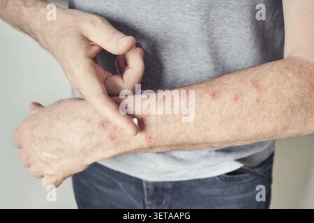 Homme adulte avec éruption cutanée lors du traitement des zones irritées sur le bras Banque D'Images