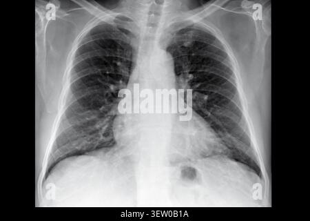 Radiographie thoracique vue PA montrant les poumons, les côtes et les épaules à des fins de diagnostic médical. Examen de radiologie clinique, bilan de santé respiratoire, évaluation orthopédique Banque D'Images