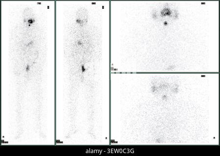 TEP-TDM ou scanner nucléaire d'un patient montrant un squelette normal du corps entier. Diagnostics avancés en médecine nucléaire et imagerie moléculaire. Banque D'Images