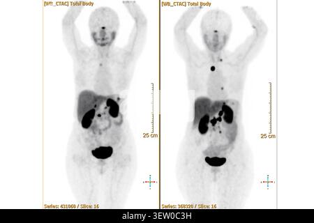 TEP-TDM ou scanner nucléaire d'un patient montrant un squelette normal du corps entier. Diagnostics avancés en médecine nucléaire et imagerie moléculaire. Banque D'Images