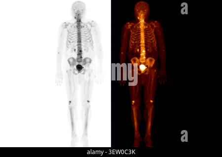 TEP-TDM ou scanner nucléaire d'un patient montrant un squelette normal du corps entier. Diagnostics avancés en médecine nucléaire et imagerie moléculaire. Banque D'Images