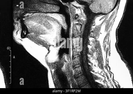 Radiographie IRM du cou et du rachis cervical Banque D'Images