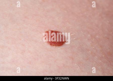 Un grain de beauté bénin sur le corps. Examen médical. Névus intradermique. Banque D'Images