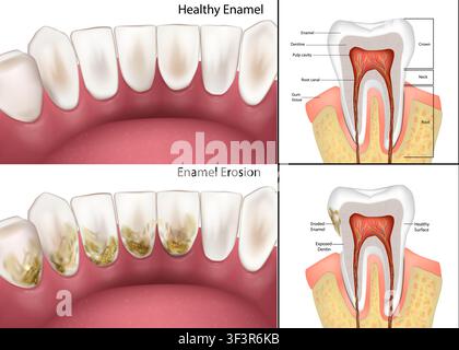 Illustration vectorielle médicale comparant des dents saines à une érosion de l'émail. Une coupe détaillée met en évidence l'émail, la dentine, la cavité pulpaire et la racine Illustration de Vecteur