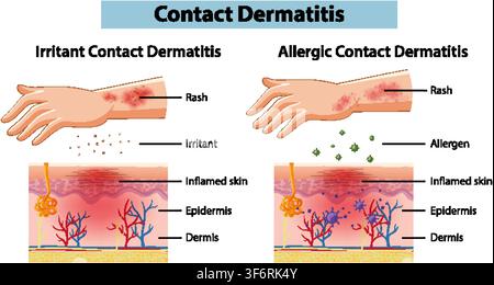 Illustration vectorielle didactique expliquant les types de dermatite de contact avec des couches cutanées en coupe transversale et des parties anatomiques étiquetées. Illustration de Vecteur