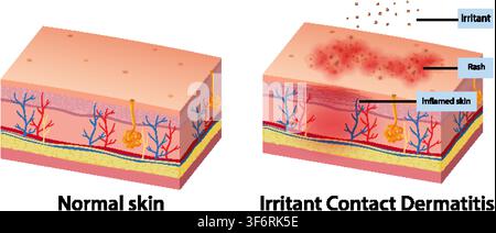 Illustration vectorielle de coupe anatomique comparant les couches de peau saines avec un tissu enflammé et une éruption allergique. Illustration de Vecteur