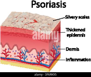 Diagramme anatomique détaillé de la psoriasis montrant une épiderme épaissie, des squames argentées et une inflammation dans les couches cutanées. Illustration de Vecteur