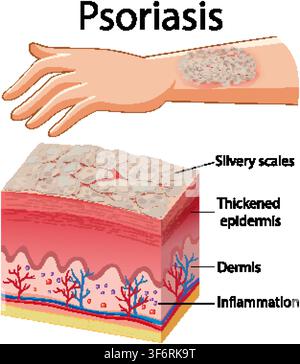Diagramme didactique vectoriel montrant les symptômes du psoriasis sur un bras humain et une coupe transversale des couches cutanées. Illustration de Vecteur