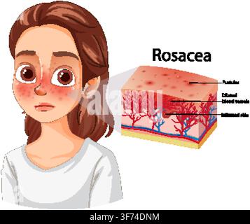 Diagramme vectoriel pédagogique montrant les symptômes de la rosacée sur le visage d'une femme avec un détail de coupe transversale de la peau. Illustration de Vecteur