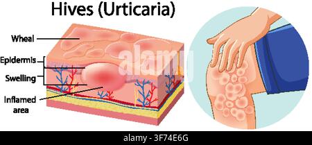 Diagramme vectoriel médical illustrant les couches de la peau, les plaques d'urticaire et une personne grattant une éruption cutanée démangeante. Illustration de Vecteur