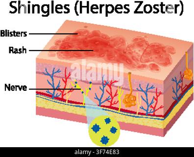 Illustration vectorielle didactique montrant les couches de la peau, les nerfs, les ampoules et l'éruption cutanée causées par le virus de l'herpès zona. Illustration de Vecteur