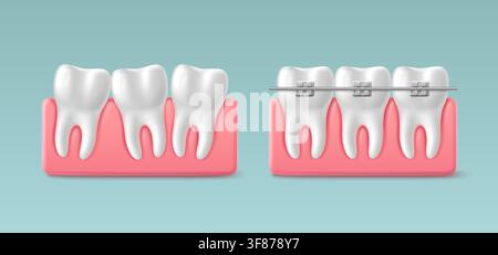 Appareil dentaire professionnel sur un modèle de dents en 3D, effet avant et après. Illustration vectorielle réaliste de brackets métalliques sur les dents, traitement orthodontique correctif pour la transformation du sourire et les soins bucco-dentaires Illustration de Vecteur