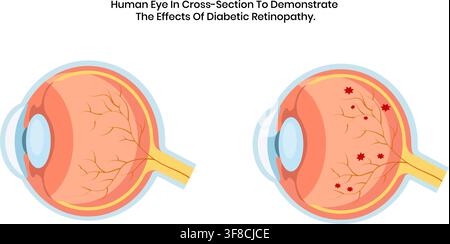Illustration médicale d'une coupe de l'œil humain comparant une rétine normale saine aux effets dommageables sévères de la maladie de rétinopathie diabétique Illustration de Vecteur
