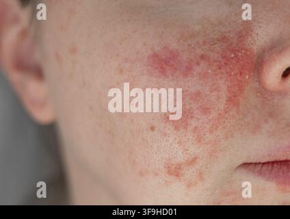 Close-up du visage d'une jeune femme présentant des irritations cutanées visibles et des rougeurs. Peau enflammée, sèche et texturée. Concept de peau sensible, d'allergie, d'inflammation Banque D'Images