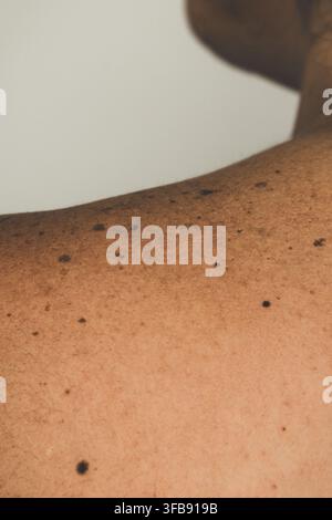 Un plan rapproché détaillé se concentrant sur la peau humaine au niveau des épaules, présentant plusieurs grains de beauté sombres, taches de rousseur et pigmentation. Très pertinent Banque D'Images