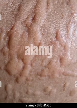Les plaques surélevées et gonflées ainsi que la texture inflammée d'une éruption cutanée d'urticaire aiguë. Banque D'Images