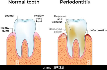 Comparaison entre une dent normale et une parodontite montrant la plaque dentaire, le tartre, l'inflammation des gencives et la perte osseuse Illustration de Vecteur