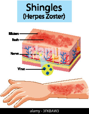 Diagramme en coupe des couches cutanées montrant l'éruption de zona, les vésicules, les nerfs et les détails de l'infection virale. Illustration de Vecteur