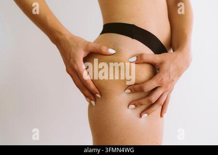 Grossissement de la jambe d'une jeune femme avec des vergetures sur sa cuisse Banque D'Images