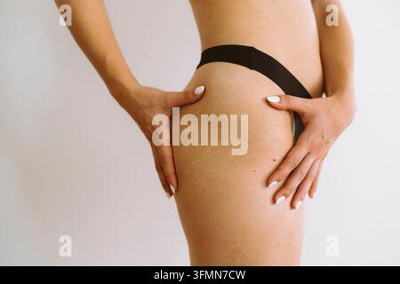 Grossissement de la jambe d'une jeune femme avec des vergetures sur sa cuisse Banque D'Images