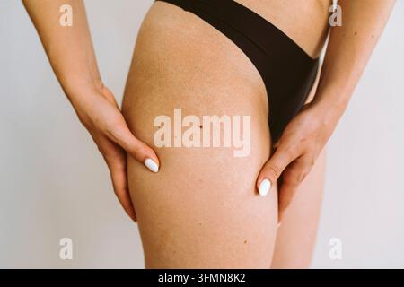 Grossissement de la jambe d'une jeune femme avec des vergetures sur sa cuisse Banque D'Images