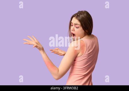 Dermatologie et allergie cutanée, jeune femme avec une éruption rouge sur le bras et l'épaule, ressentant des démangeaisons et une irritation, condition de santé médicale sur fond violet Banque D'Images