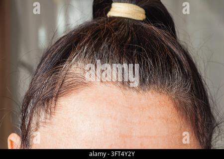 Ce plan détaillé se concentre sur le front et le cuir chevelu, mettant en évidence la texture de la peau et la densité des cheveux aux tempes Banque D'Images