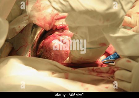 Close up de la tête au cours d'une nouvelle césarienne en théâtre au cours d'une naissance. Banque D'Images