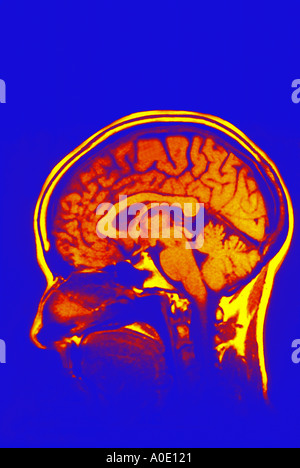 IRM du cerveau Banque D'Images