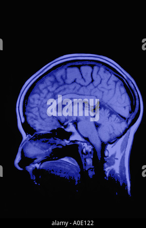 IRM du cerveau Banque D'Images