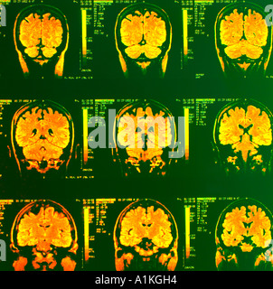 Les rayons colorés de cortex cérébral cervelet IRM du cerveau humain Banque D'Images