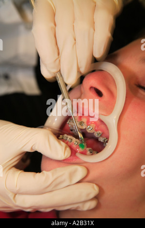 Renfort métal bandes bleu dents lèvres peau réparation dentaire orthodontique ortho bouche Banque D'Images