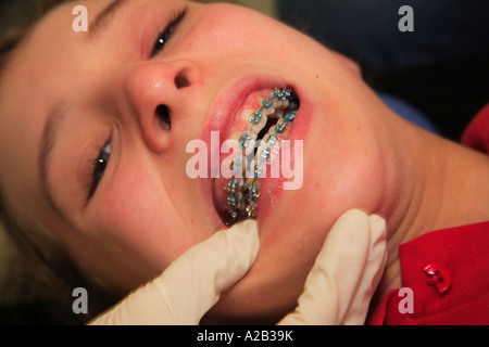 Renfort métal bandes bleu dents lèvres peau réparation dentaire orthodontique ortho bouche Banque D'Images