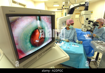 Opération de la cataracte vu en gros plan sur l'écran d'opération avec femme médecin et l'infirmière derrière. Banque D'Images