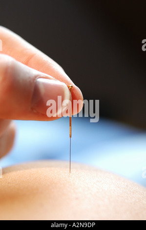 Close-up of person's hand l'insertion d'aiguille d'acupuncture sur la peau d'une autre personne Banque D'Images