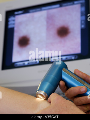 Le spécialiste de la peau MD Serko von Düben examine un patient avec un dermatoscope vidéo Banque D'Images