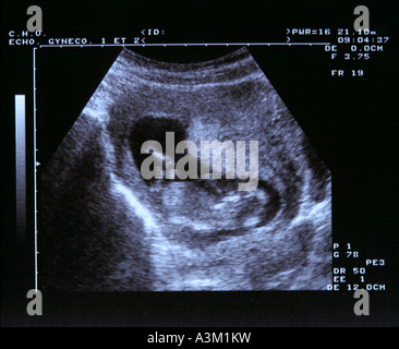 Echographie D Un Fœtus De 2 Mois Photo Stock Alamy