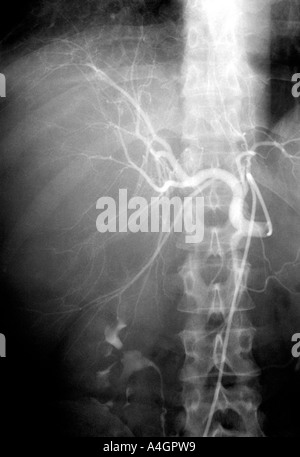 Une angiographie d'un patient atteint d'un carcinome hépatocellulaire, un cancer qui découle des hépatocytes Banque D'Images