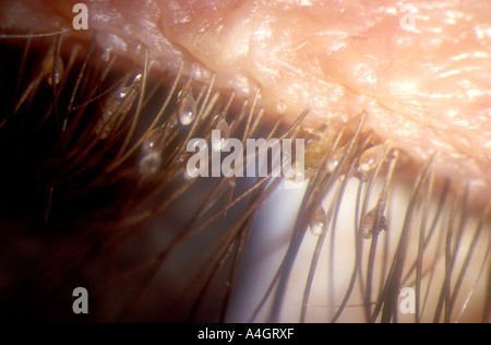 Une photographie d'un poux du pubis (phithirus pubis), un parasite ...