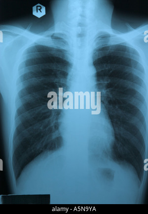 Xray de section abdominale du corps montrant les poumons Banque D'Images