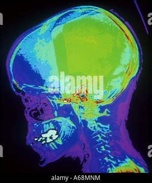 De la CAT scan couleur crâne latéral Banque D'Images