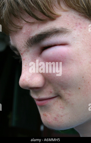 Spotty teenage boy with très enflé yeux causés par piqûre de guêpe Banque D'Images