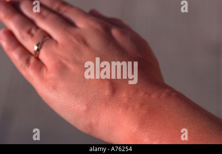 Girl s part après avoir reçu plusieurs piqûres de moustique Banque D'Images