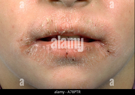 L'eczéma de lécher les lèvres Photo Stock - Alamy