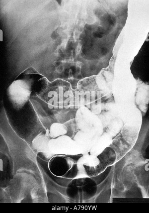 C'est une radiographie de l'abdomen d'un patient atteint de la maladie de Crohn Banque D'Images