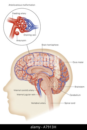 Une illustration du crâne et du cerveau montrant une malformation artérioveineuse. Banque D'Images