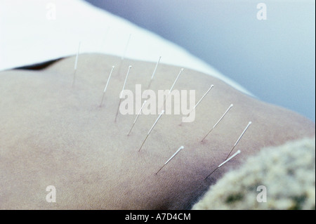 Les aiguilles d'Acupuncture en retour de womans Banque D'Images