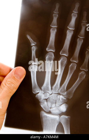 Un médecin homme contient jusqu'une radiographie d'une main pour l'examiner Banque D'Images
